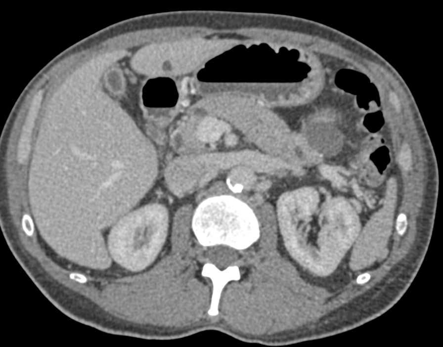 Carcinoma of the Head of the Pancreas with Dilated Pancreatic Duct - CTisus CT Scan