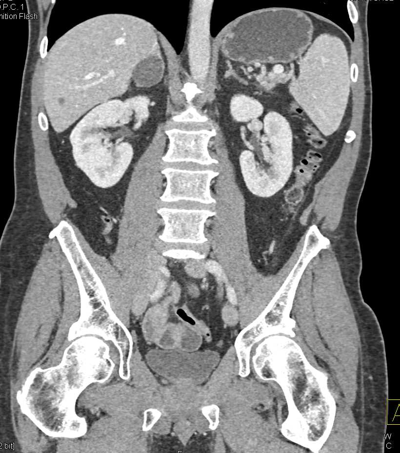 Carcinoma of the Body of the Pancreas - CTisus CT Scan