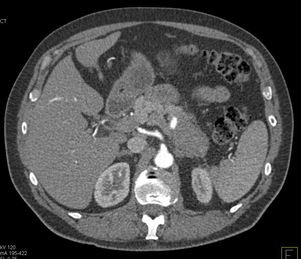 Autoimmune Pancreatitis Involves the Tail of the Pancreas - CTisus CT Scan