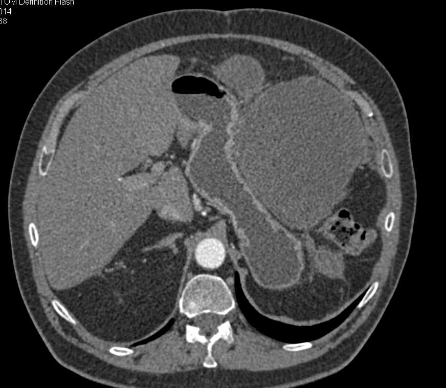 Omental Infarct Left Upper Quadrant Following Distal Pancreatectomy and Splenectomy - CTisus CT Scan