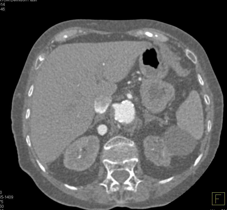 Omental Infarct Left Upper Quadrant after Distal Pancreatectomy and Splenectomy - CTisus CT Scan