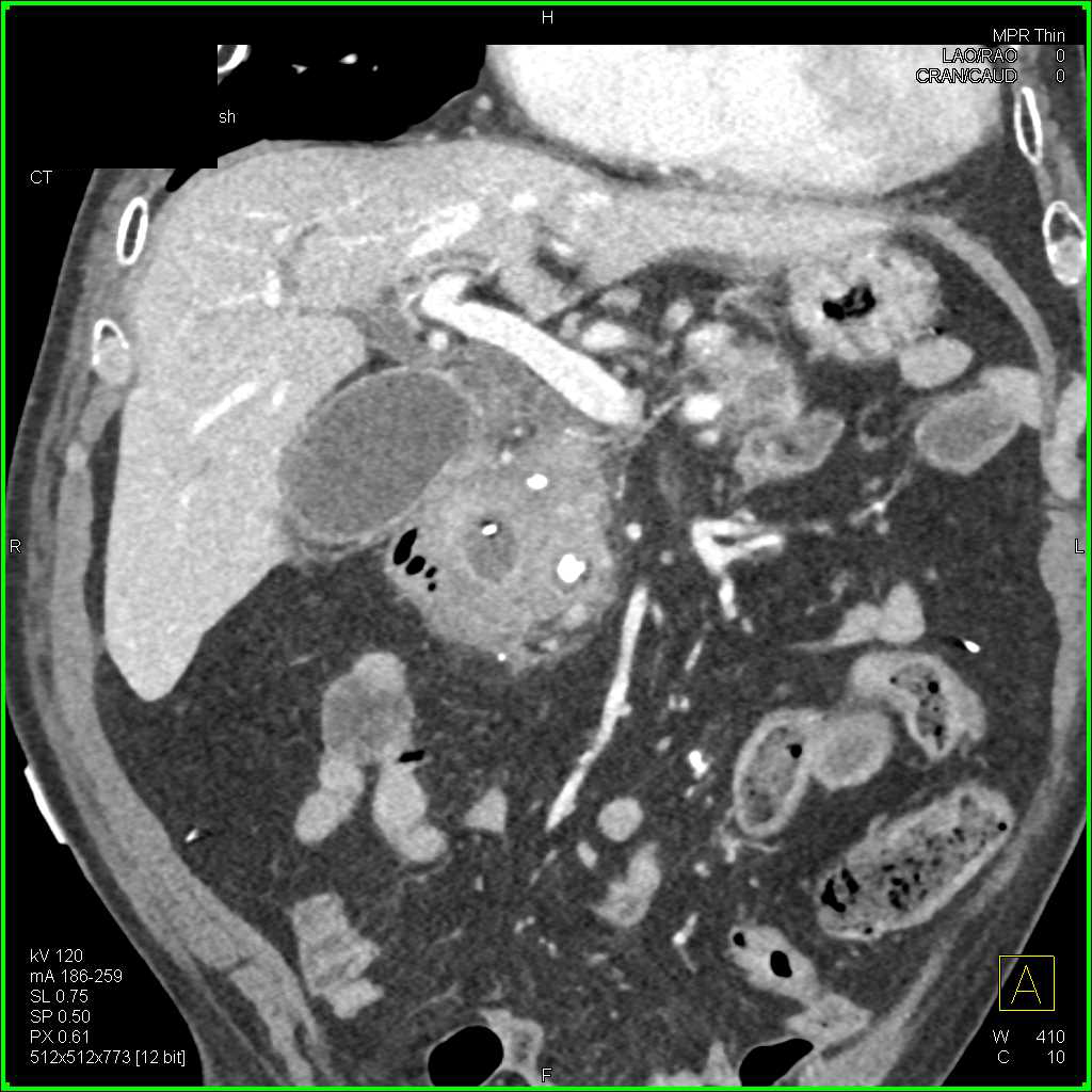 Carcinoma of the Pancreas in a Patient with Chronic Pancreatitis - CTisus CT Scan