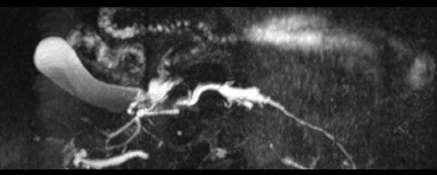 Subtle Carcinoma Head of the Pancreas - CTisus CT Scan