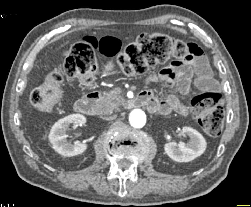 Ampullary Carcinoma Obstructs Common Bile Duct (CBD) and Invades Duodenum - CTisus CT Scan