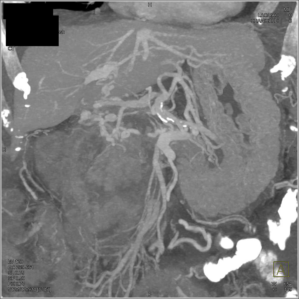 Pancreatic Cancer with Occluded Vasculature and Thickened Gastric Folds - CTisus CT Scan
