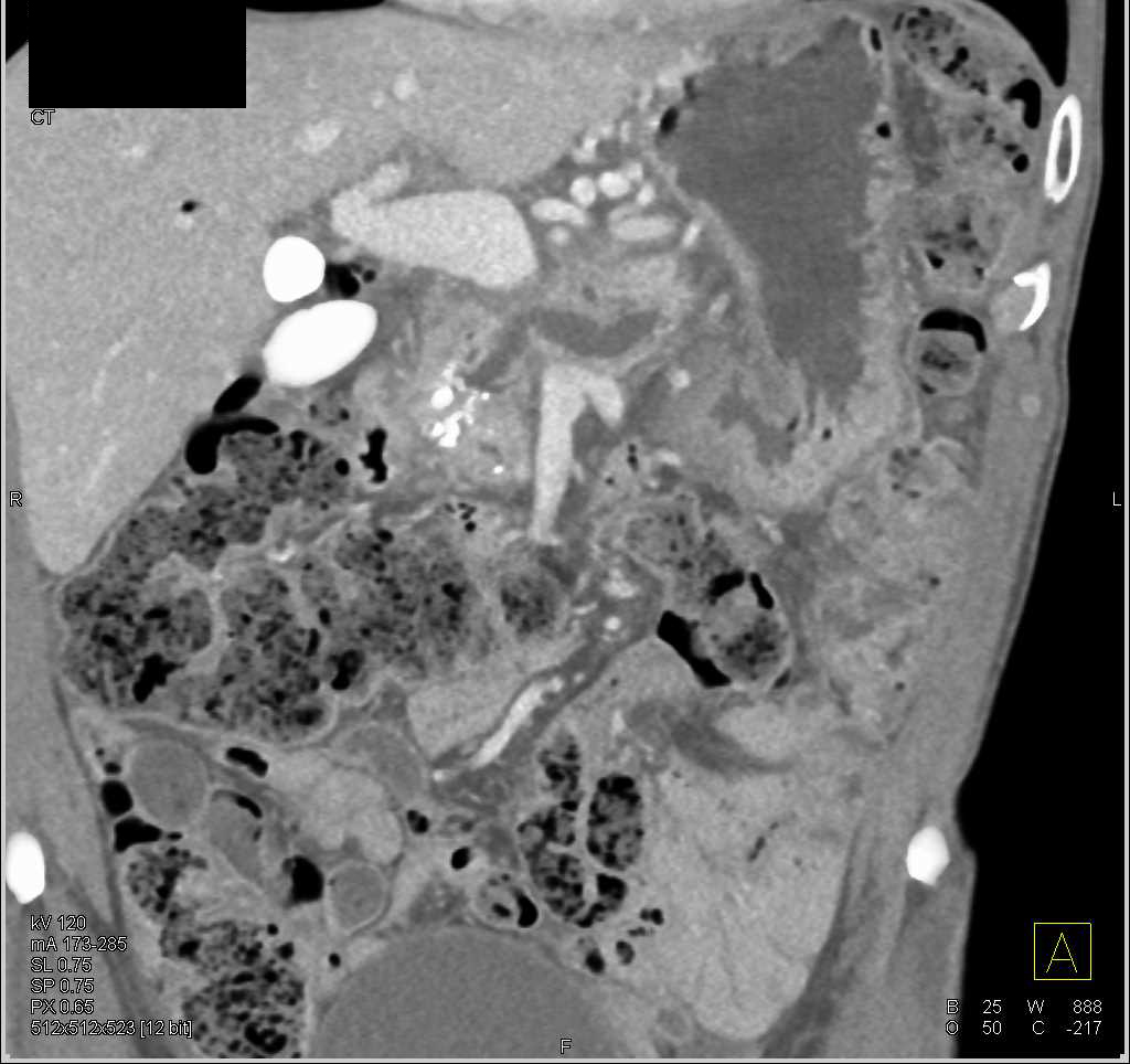 Pancreatic Cancer in the Body of the Pancreas - CTisus CT Scan