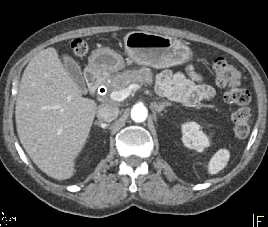 Pancreatic Cancer Incidentally Detected on Aortic Root Followup Study - CTisus CT Scan