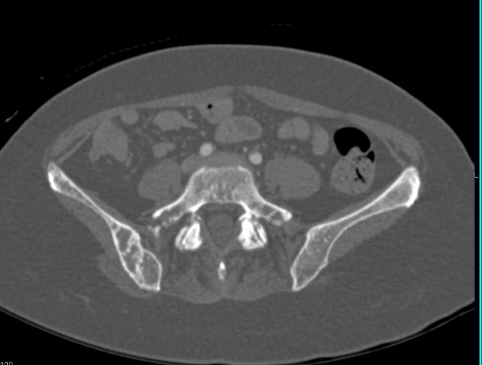 Intraductal Papillary Mucinous Neoplasm (IPMN) in a Patient with Fibrous Dysplasia - CTisus CT Scan