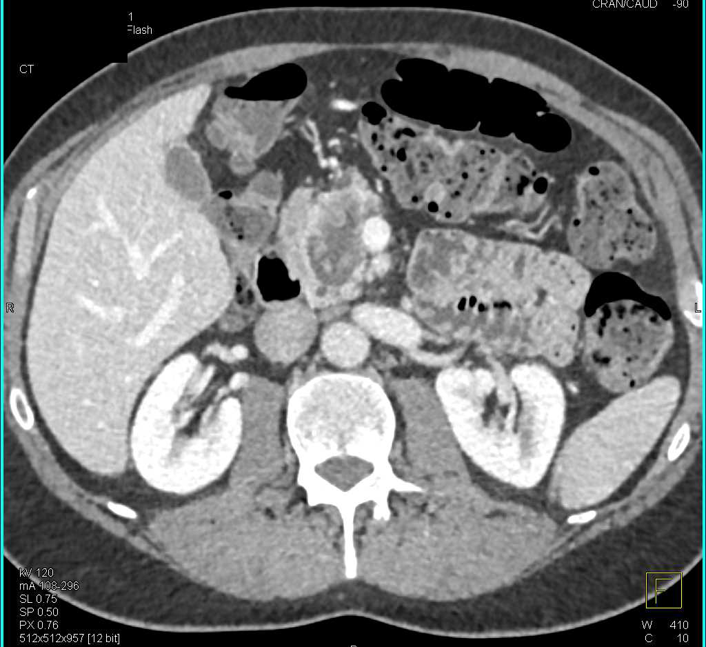 Adenocarcinoma of Head of Pancreas with Increased Vascularity - CTisus CT Scan