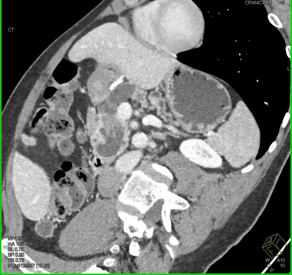 Adenocarcinoma Arising in an Intraductal Papillary Mucinous Neoplasm (IPMN) - CTisus CT Scan