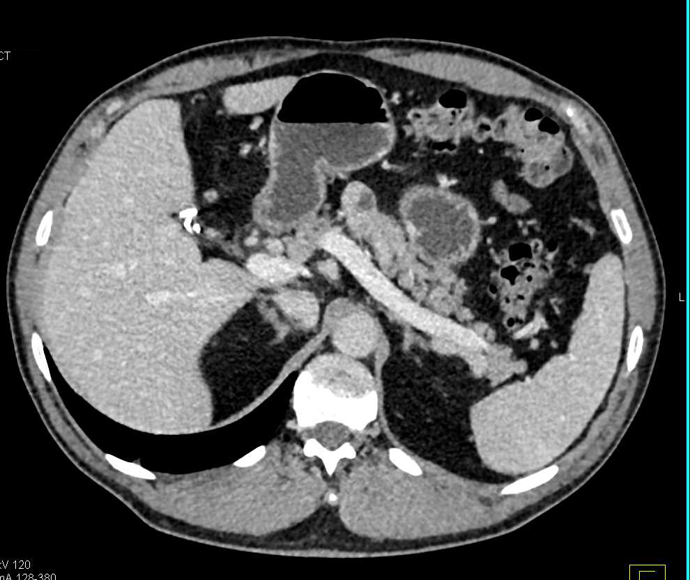 Intraductal Papillary Mucinous Neoplasm (IPMN) in Neck of Pancreas - CTisus CT Scan