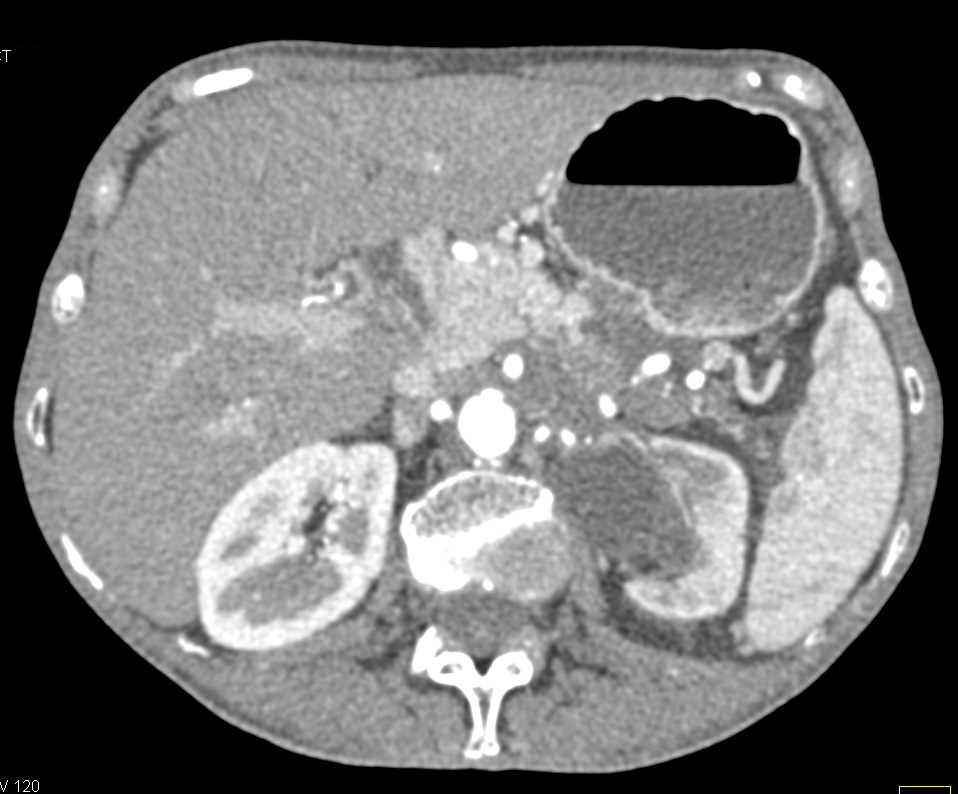Infiltrating Pancreatic Cancer Involves Obstruction 3-4th portion of Duodenum and Left Hydronephrosis - CTisus CT Scan