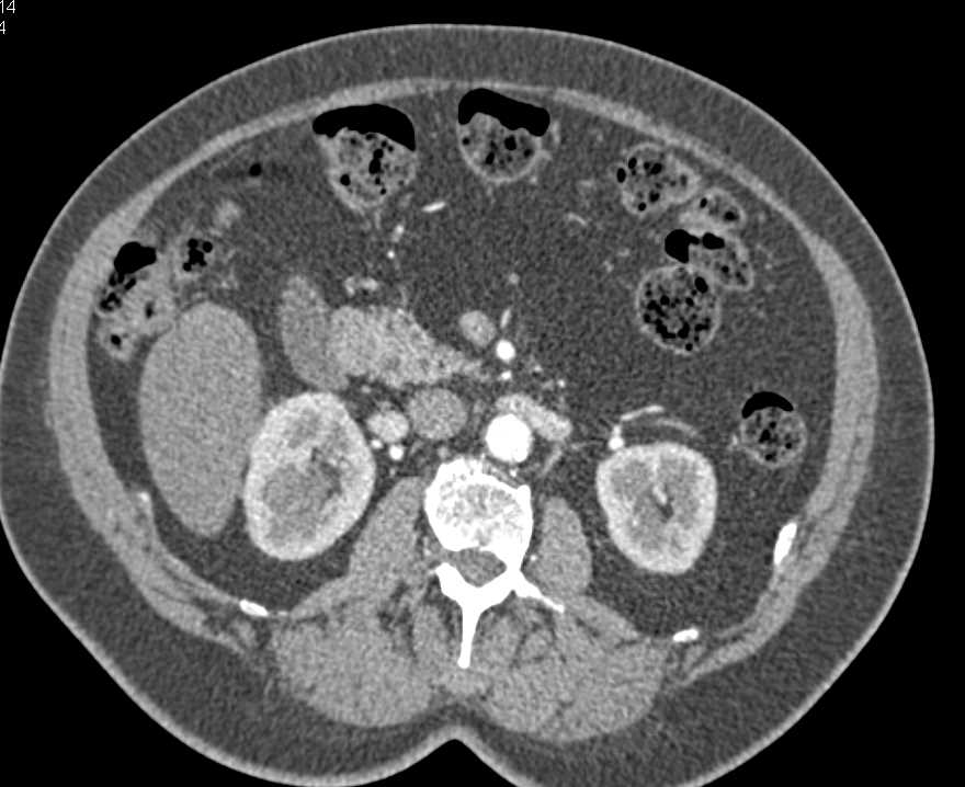 Lipoma of the Pancreas - Pancreas Case Studies - CTisus CT Scanning