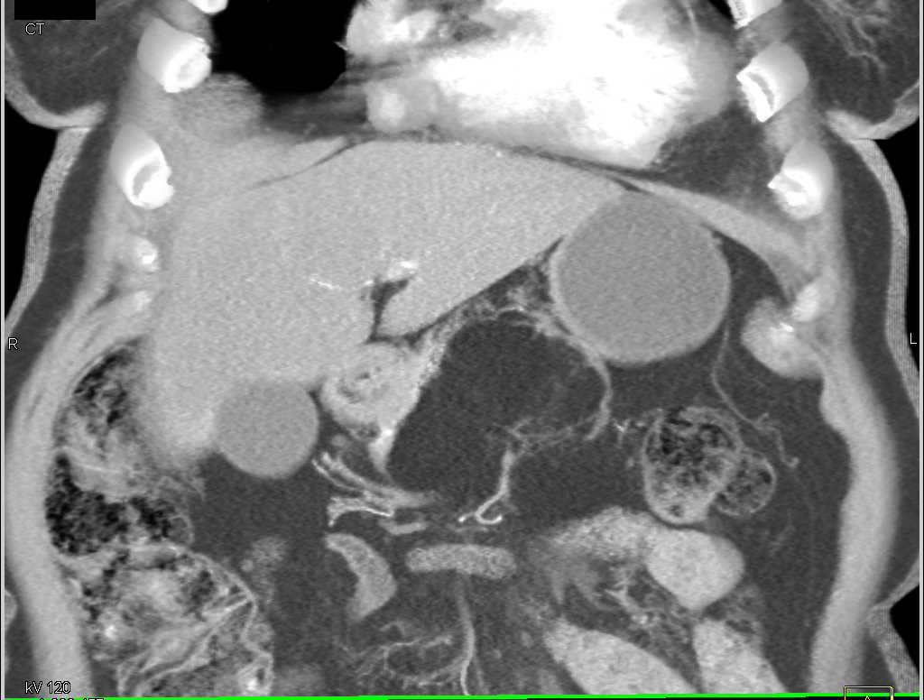 Lipoma of the Pancreas - CTisus CT Scan