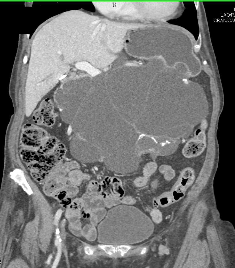 Serous Cystadenoma of the Pancreas - CTisus CT Scan