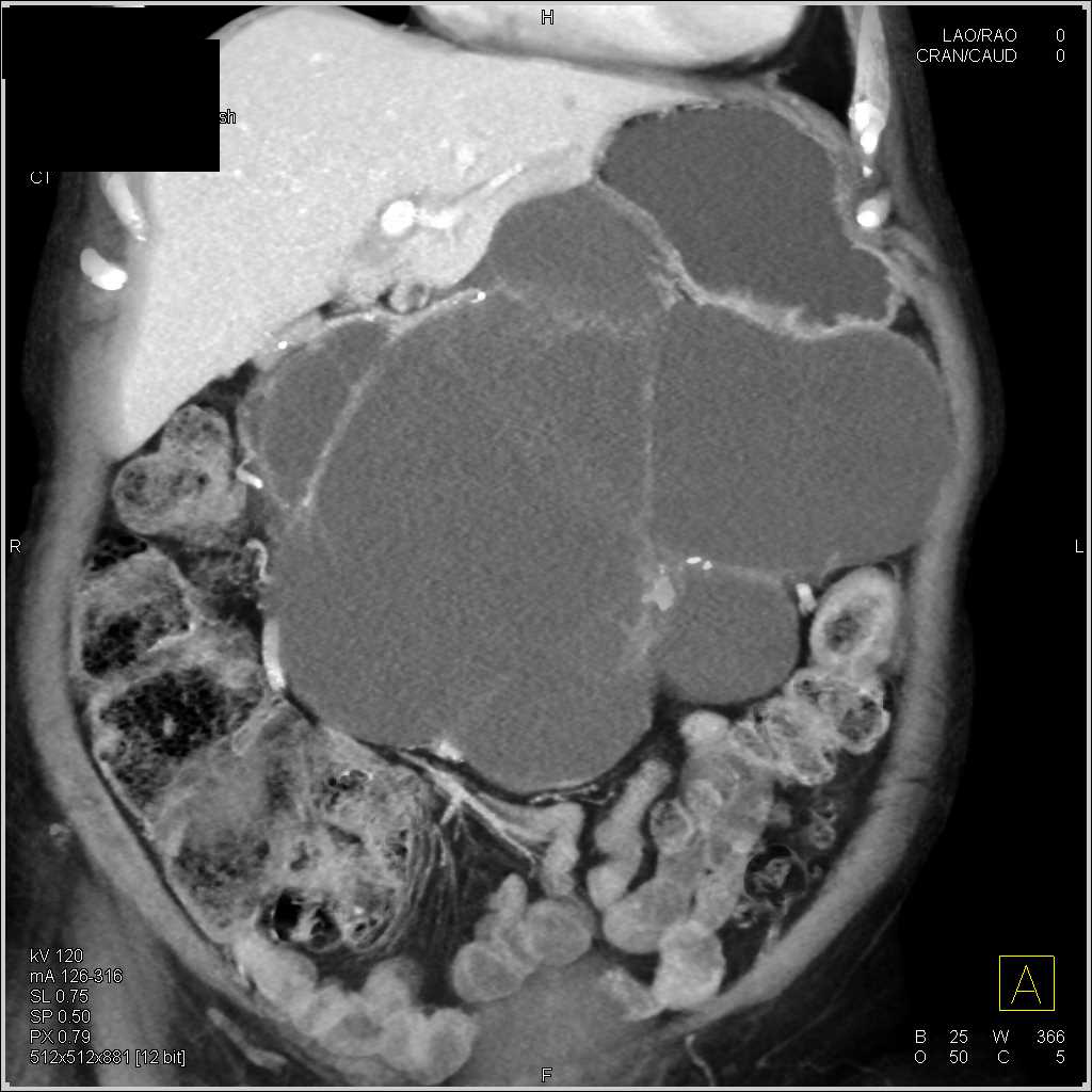 Serous Cystadenoma of the Pancreas - CTisus CT Scan