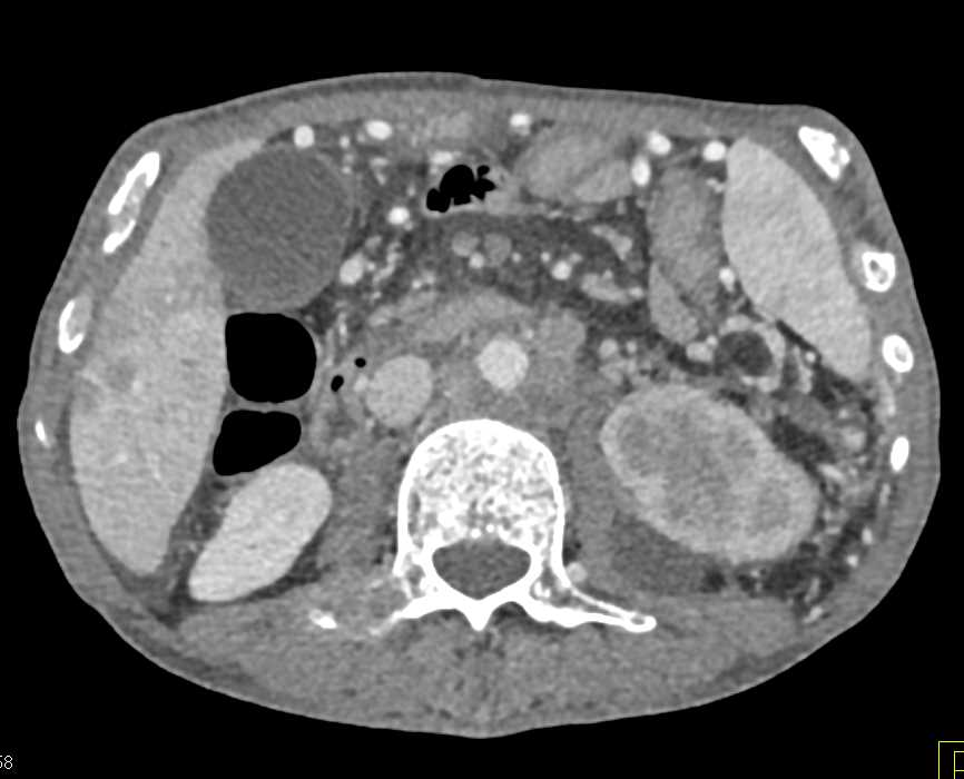 Pancreatic Cancer with Liver Metastases, Adenopathy and Carcinomatosis - CTisus CT Scan