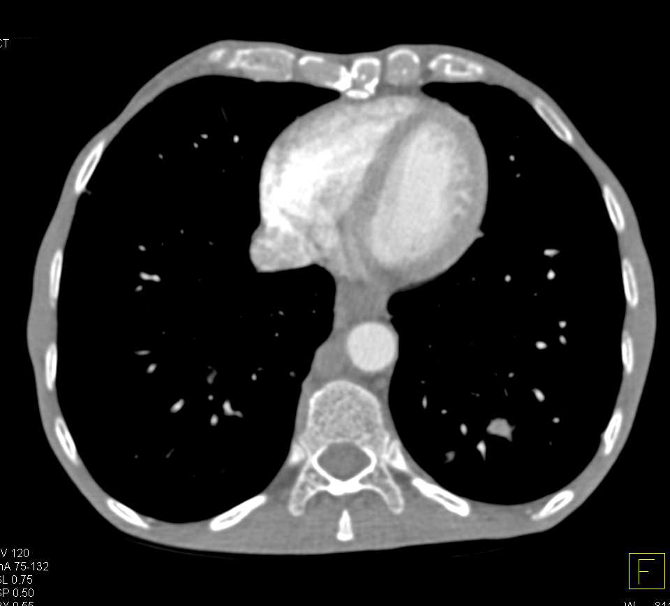 Pancreatic Cancer with Liver Metastases, Adenopathy and Carcinomatosis - CTisus CT Scan