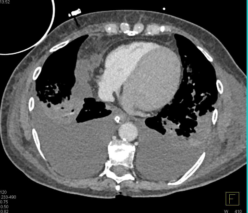 Necrotizing Pancreatitis with Secondary Complications - CTisus CT Scan