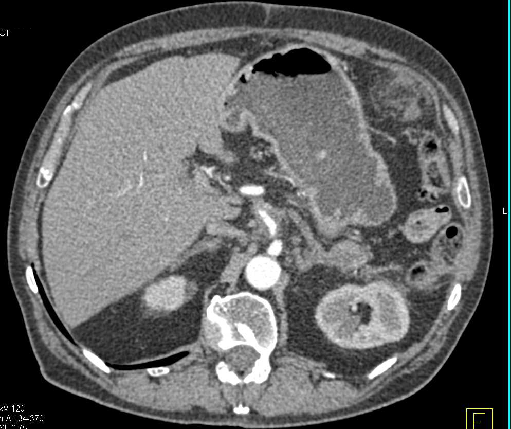 Pancreatic Cancer with Carcinomatosis - CTisus CT Scan