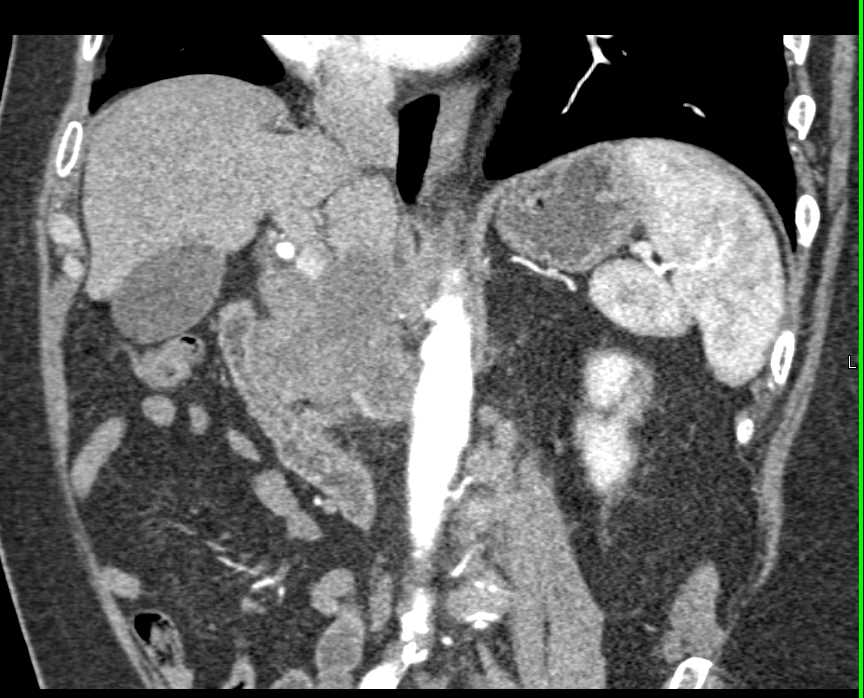 Pancreatic Adenocarcinoma with Adenopathy - CTisus CT Scan