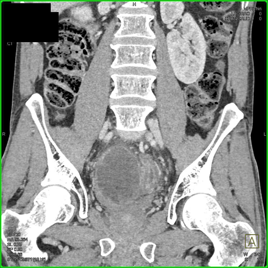 Pancreatic Cancer with Pelvic Metastases - CTisus CT Scan