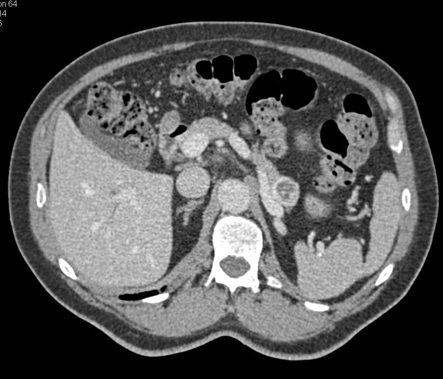 Metastatic Neuroendocrine Tumor Tail of the Pancreas - CTisus CT Scan