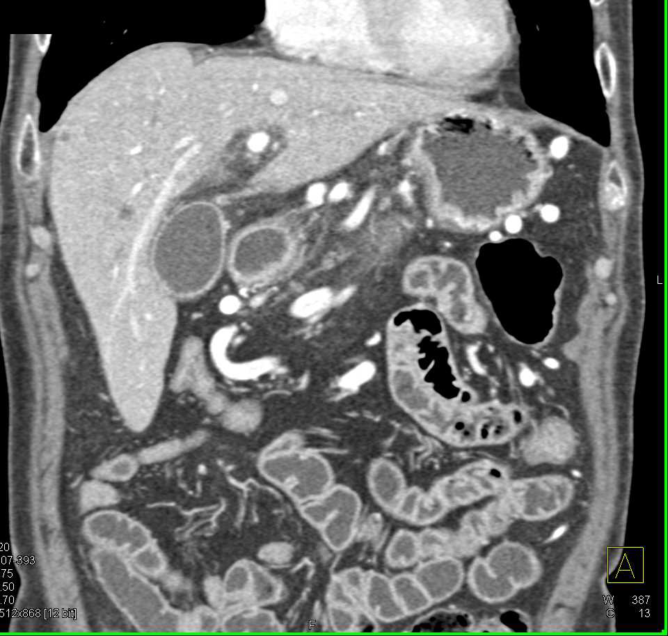 Pancreatic Adenocarcinoma with Vascular Invasion and Liver Metastases - CTisus CT Scan