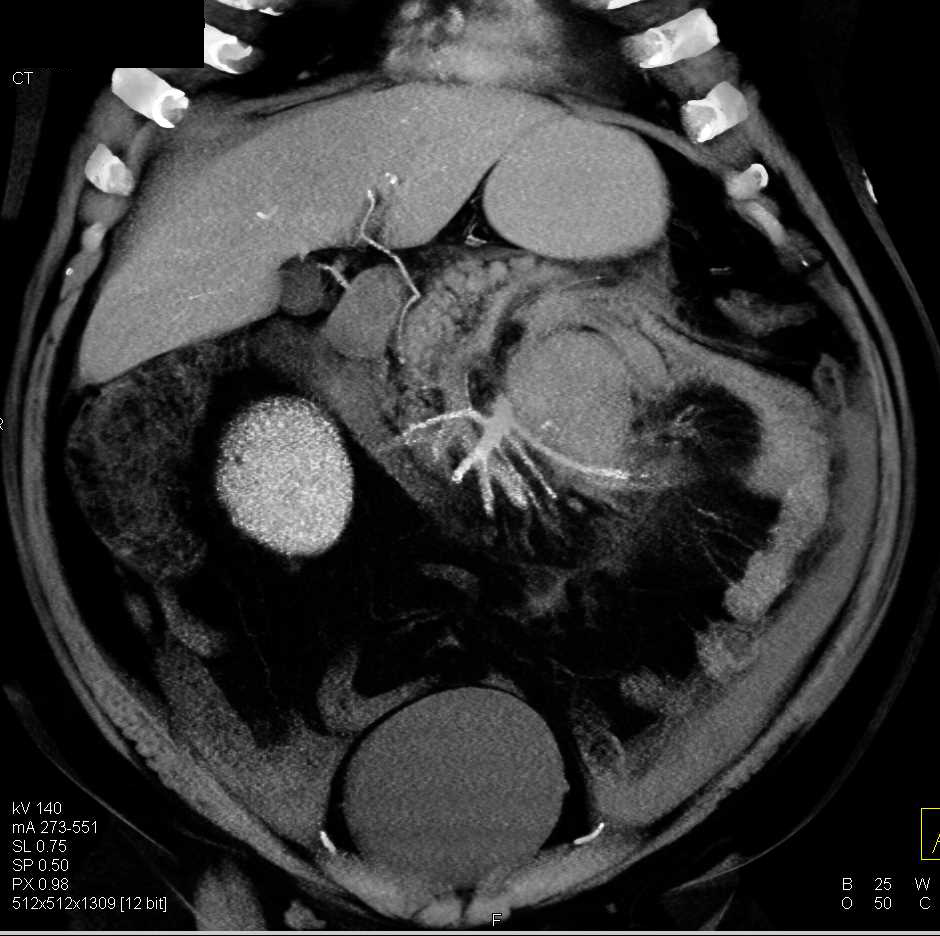 Acute Pancreatitis with Inflamed Momentum - CTisus CT Scan