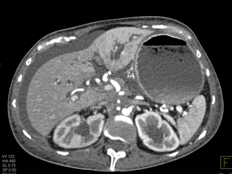 Pancreatic Adenocarcinoma with Arterial and Venous Encasement - CTisus CT Scan