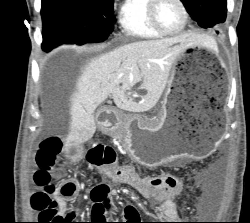 Pancreatic Adenocarcinoma with Arterial and Venous Encasement and Carcinomatosis - CTisus CT Scan