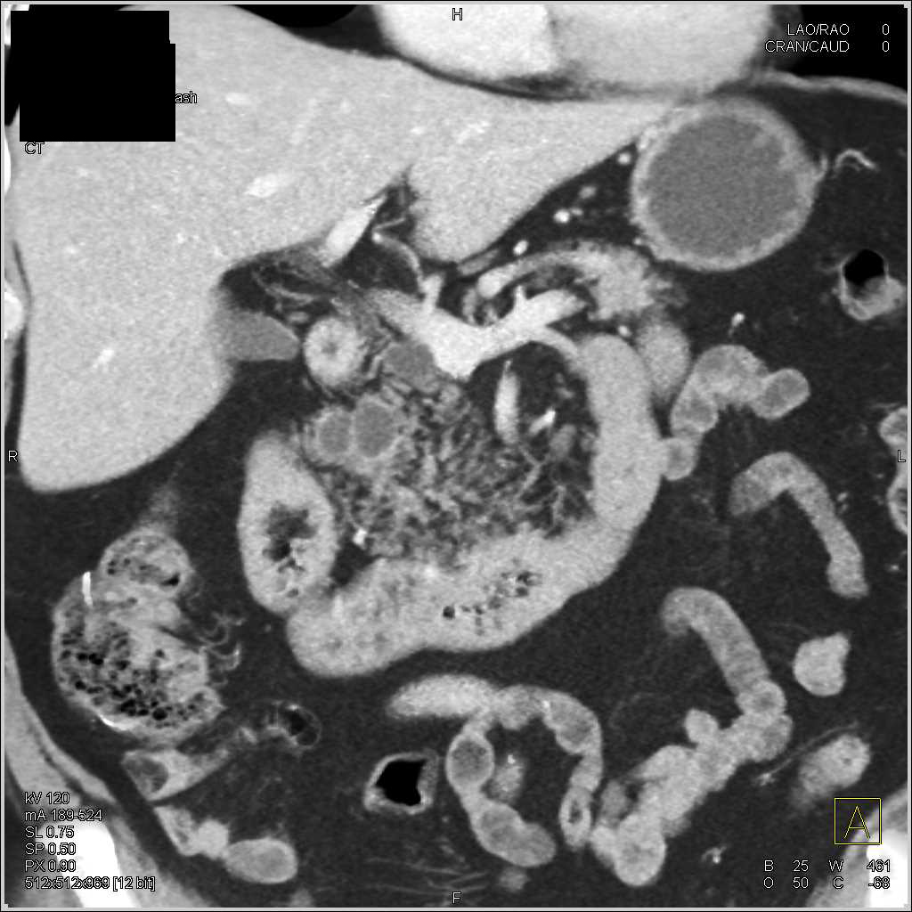 Intraductal Papillary Mucinous Neoplasm (IPMN) in Head of the Pancreas - CTisus CT Scan