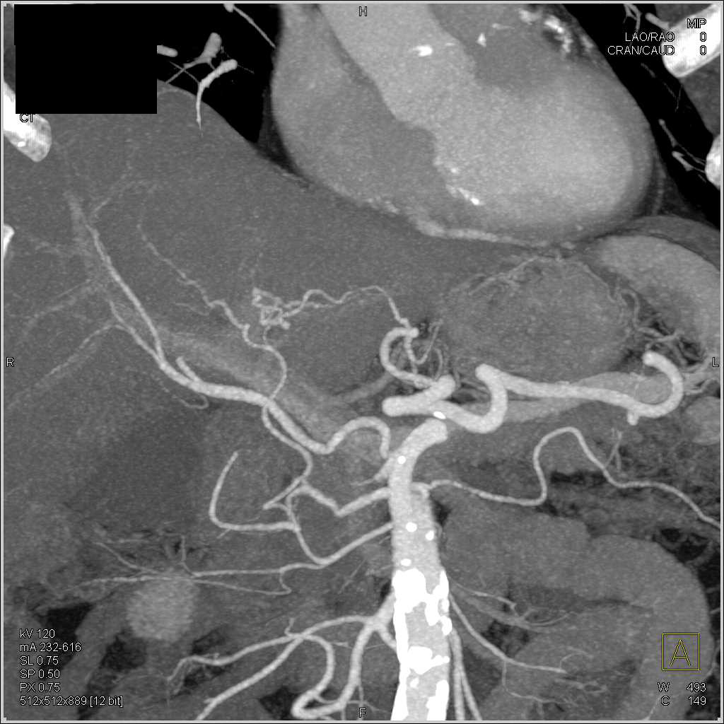 Carcinoma of the Head of the Pancreas - CTisus CT Scan