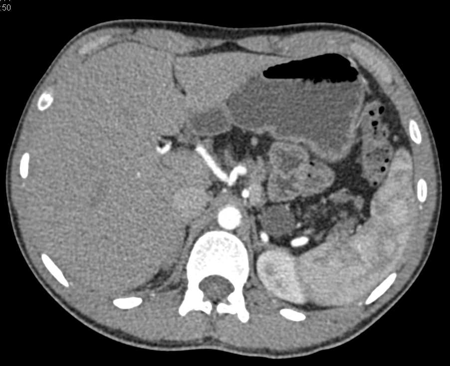 Cystic Fibrosis with Cystic Lesions in Head of Pancreas - CTisus CT Scan