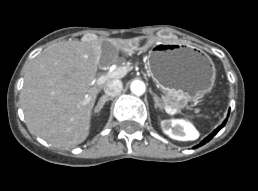 Subtle Carcinoma Tail of the Pancreas - CTisus CT Scan