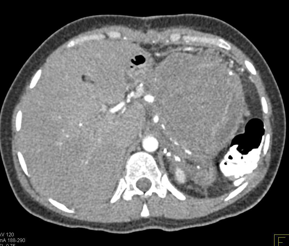 SPEN Tumor Pancreatic Tail (Solid and Papillary Epithelial Neoplasm) - CTisus CT Scan