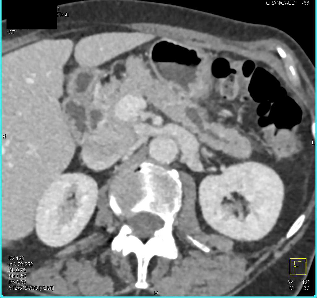 Small Neuroendocrine Tumor Obstructs the Pancreatic Duct - CTisus CT Scan