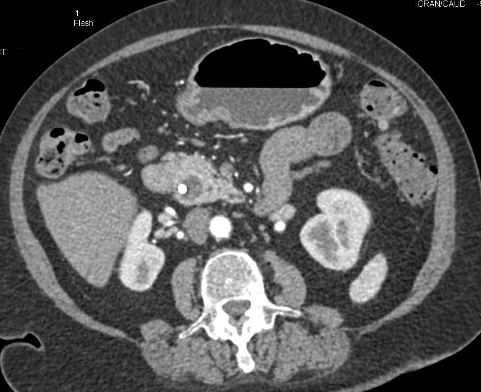 Ampullary Lesion Obstructes the Common Bile Duct - CTisus CT Scan