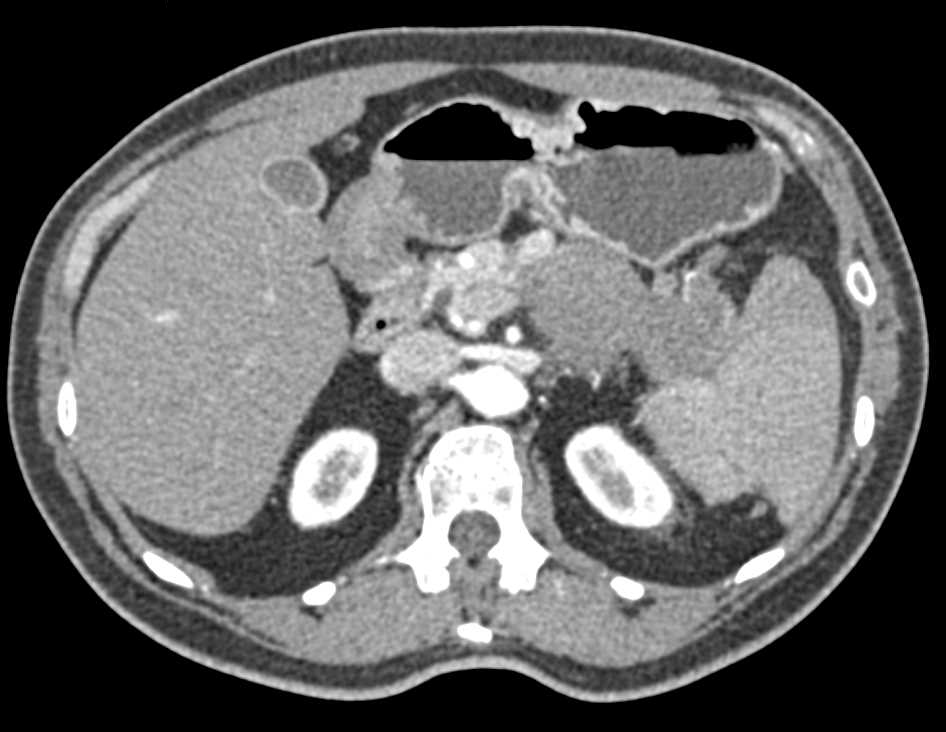 Carcinoma Tail of Pancreas Invades the Spleen - CTisus CT Scan