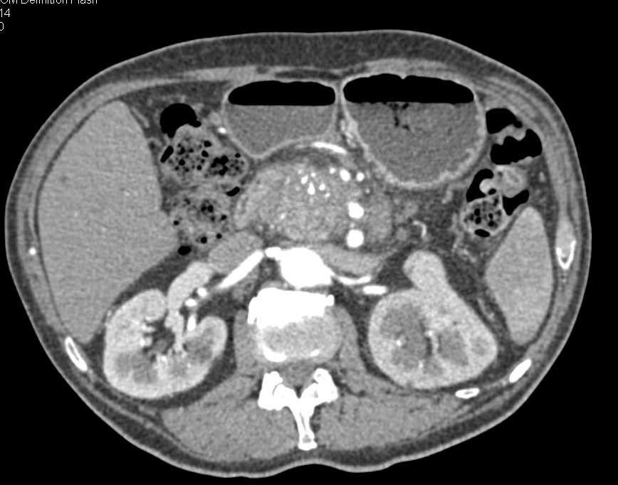 Chronic Pancreatitis with Pseudocyst Extends into the Spleen - CTisus CT Scan