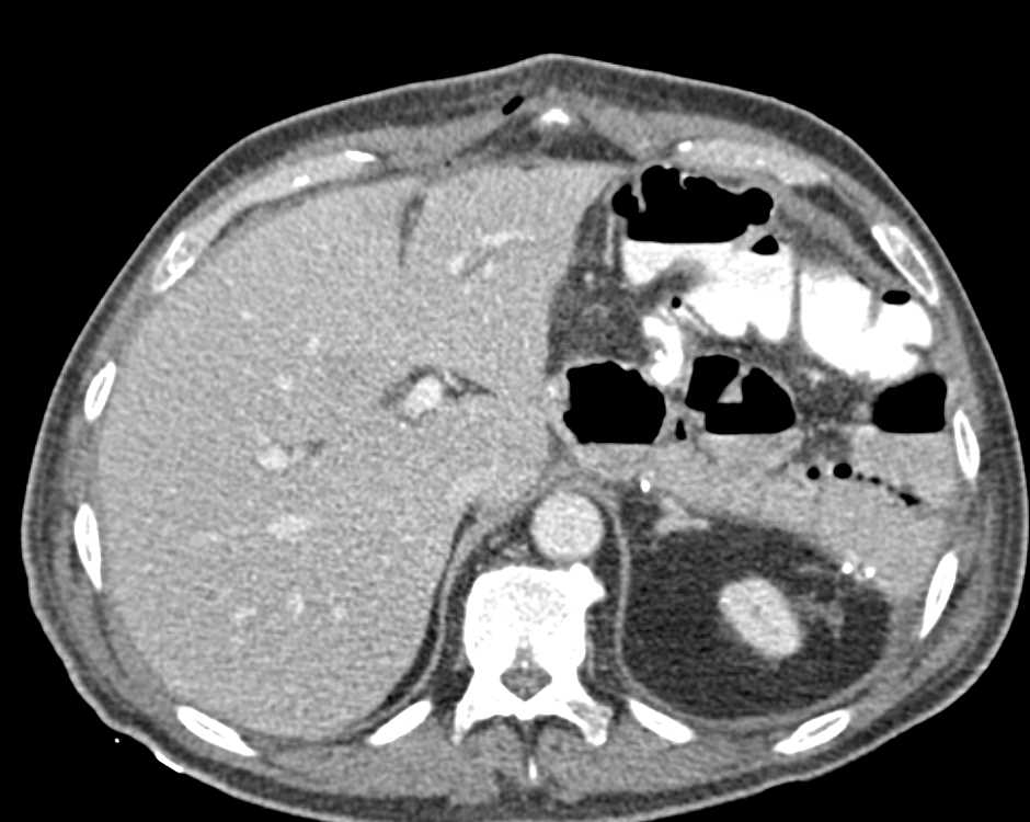 Pneumatosis Small Bowel S/P Distal Pancreatectomy and Splenectomy - CTisus CT Scan