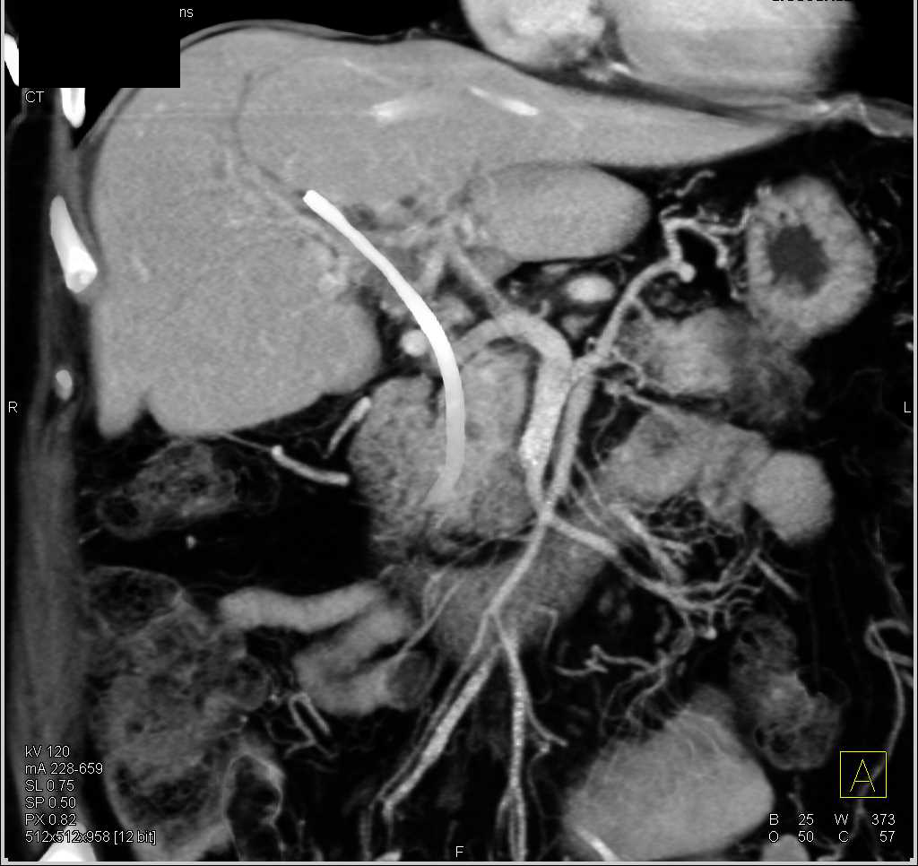 Metastatic Pancreatic Cancer with Carcinomatosis - CTisus CT Scan