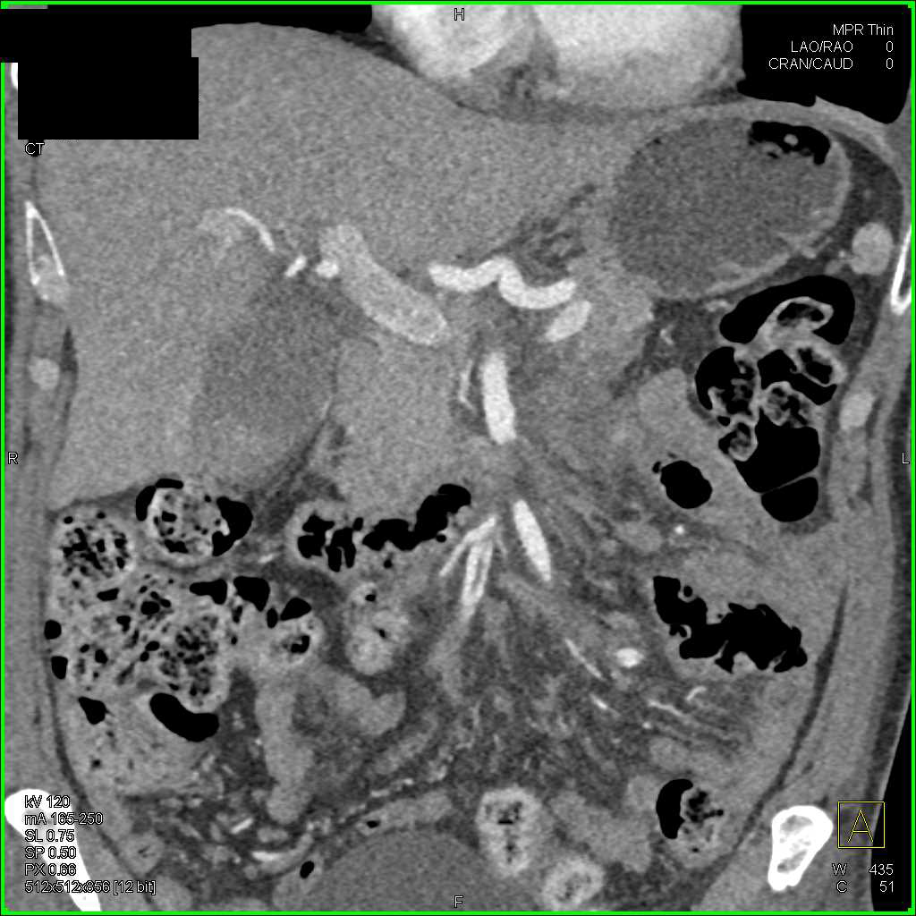 Superior Mesenteric Artery (SMA) Encased by Pancreatic Cancer - CTisus CT Scan