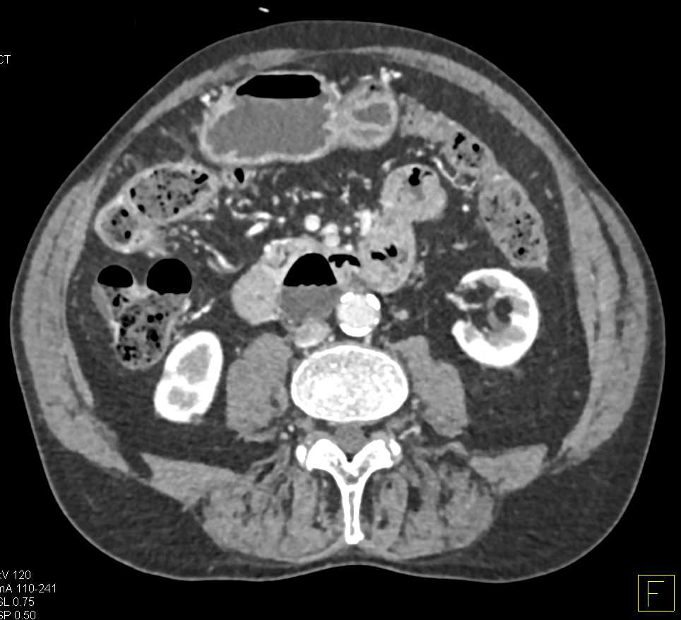 Intraductal Papillary Mucinous Neoplasm (IPMN) Head of Pancreas - CTisus CT Scan