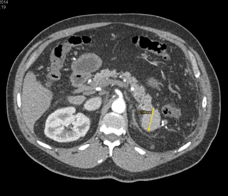 Accessory Spleen Simulates a Neuroendocrine Tumor of the Tail of the Pancreas - CTisus CT Scan