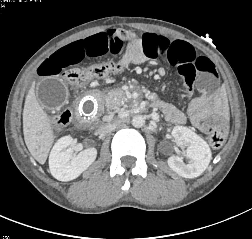 Invasive Pancreatic Cancer with Duodenal Stent - CTisus CT Scan