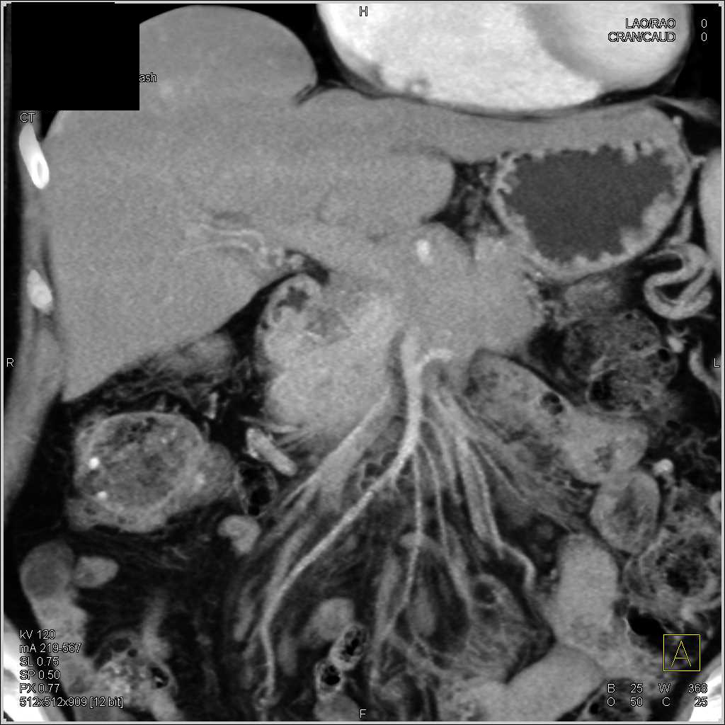 Pancreatic Adenocarcinoma with Bulky Adenopathy and Vascular Invasion - CTisus CT Scan