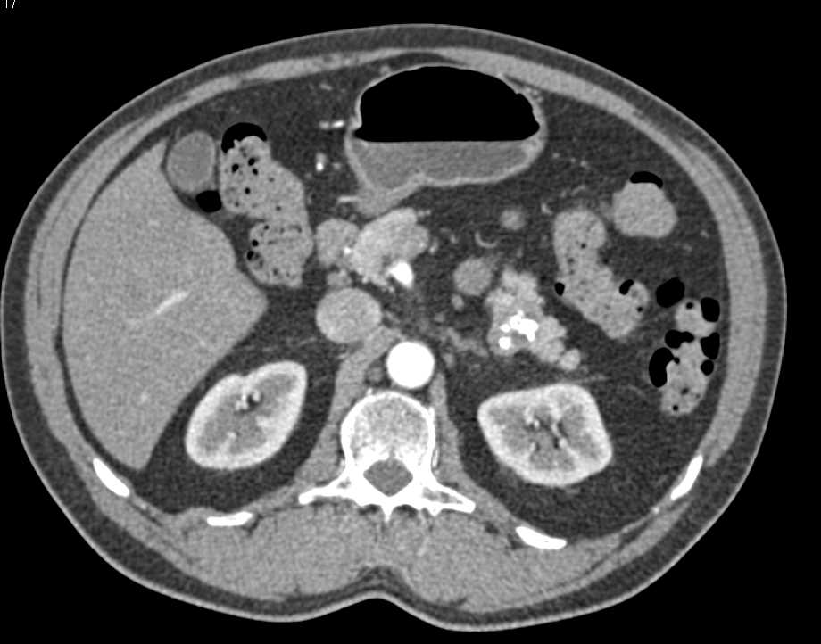 Serous Cystadenoma of the Pancreas with Calcification - CTisus CT Scan