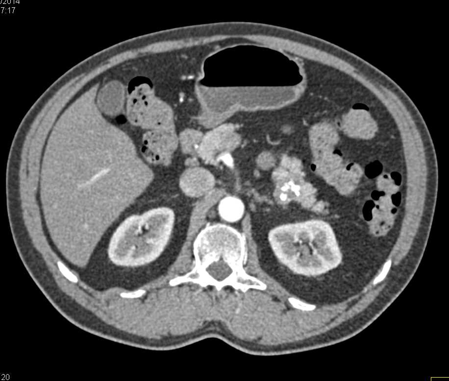 Serous Cystadenoma with Calcification - CTisus CT Scan