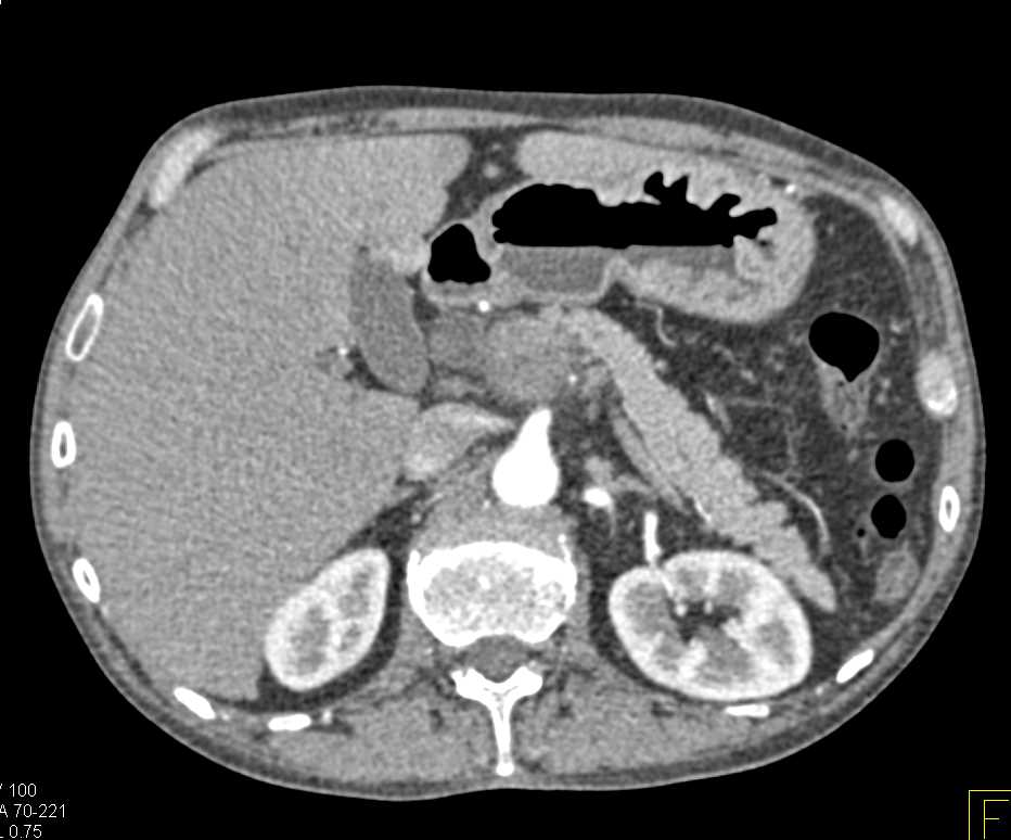 Peripancreatic Adenopathy and Implants - CTisus CT Scan